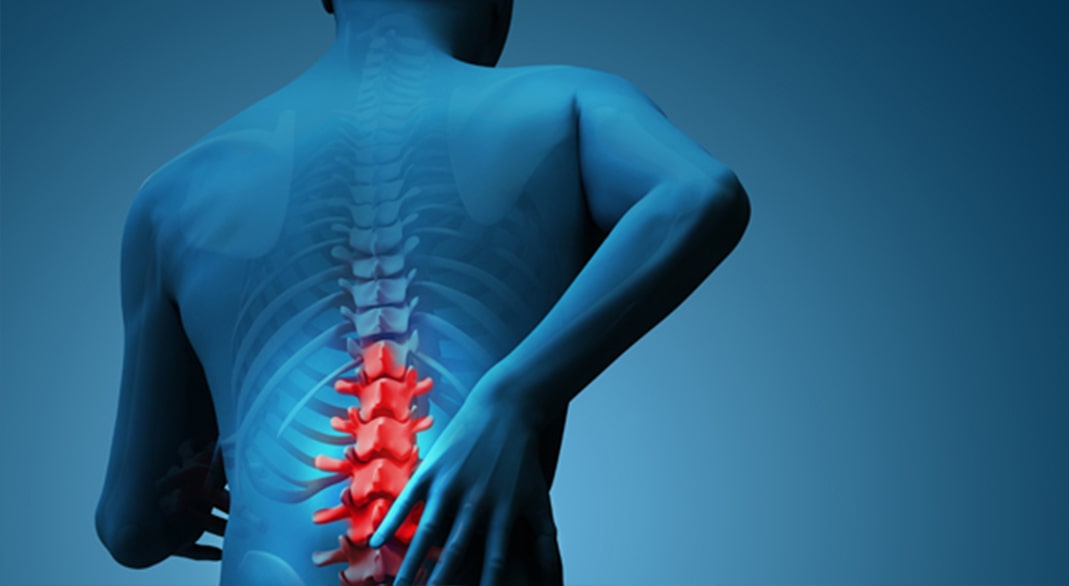 Non-surgical Spinal Disk Hernia Treatment