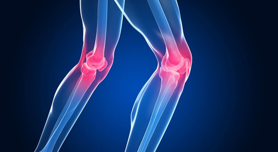Knee Steoarthritis
