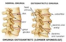 Omurga Osteoartrit