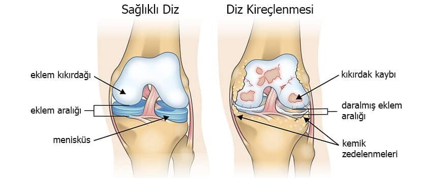 Sağlıklı diz ve diz kireçlenmesi karşılaştırma görseli