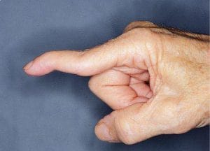 Swan Neck Deformasiyasi